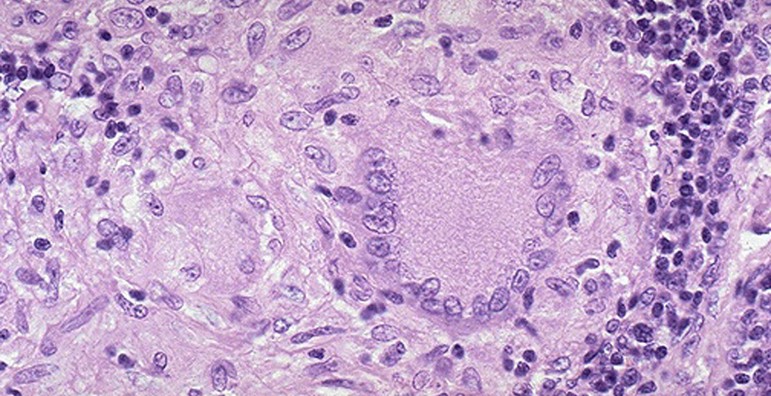 mycobacteriumtuberculosis