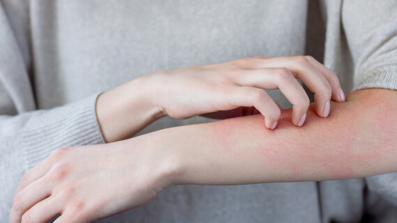 scabies-study-header