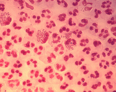 Gonococcal_urethritis_PHIL_4085_lores
