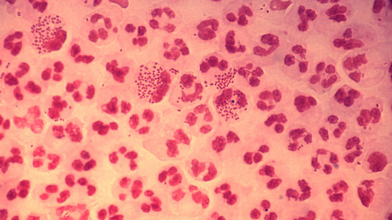 Gonococcal_urethritis_PHIL_4085_lores