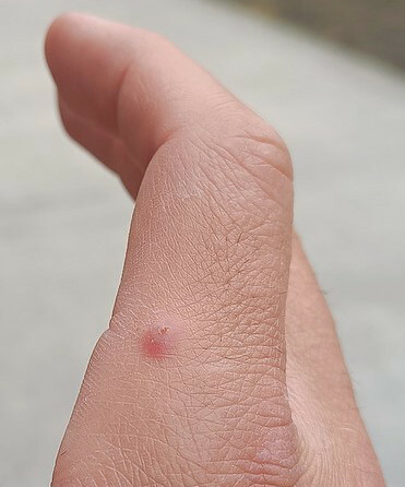 Case1_finger_lesions_resized