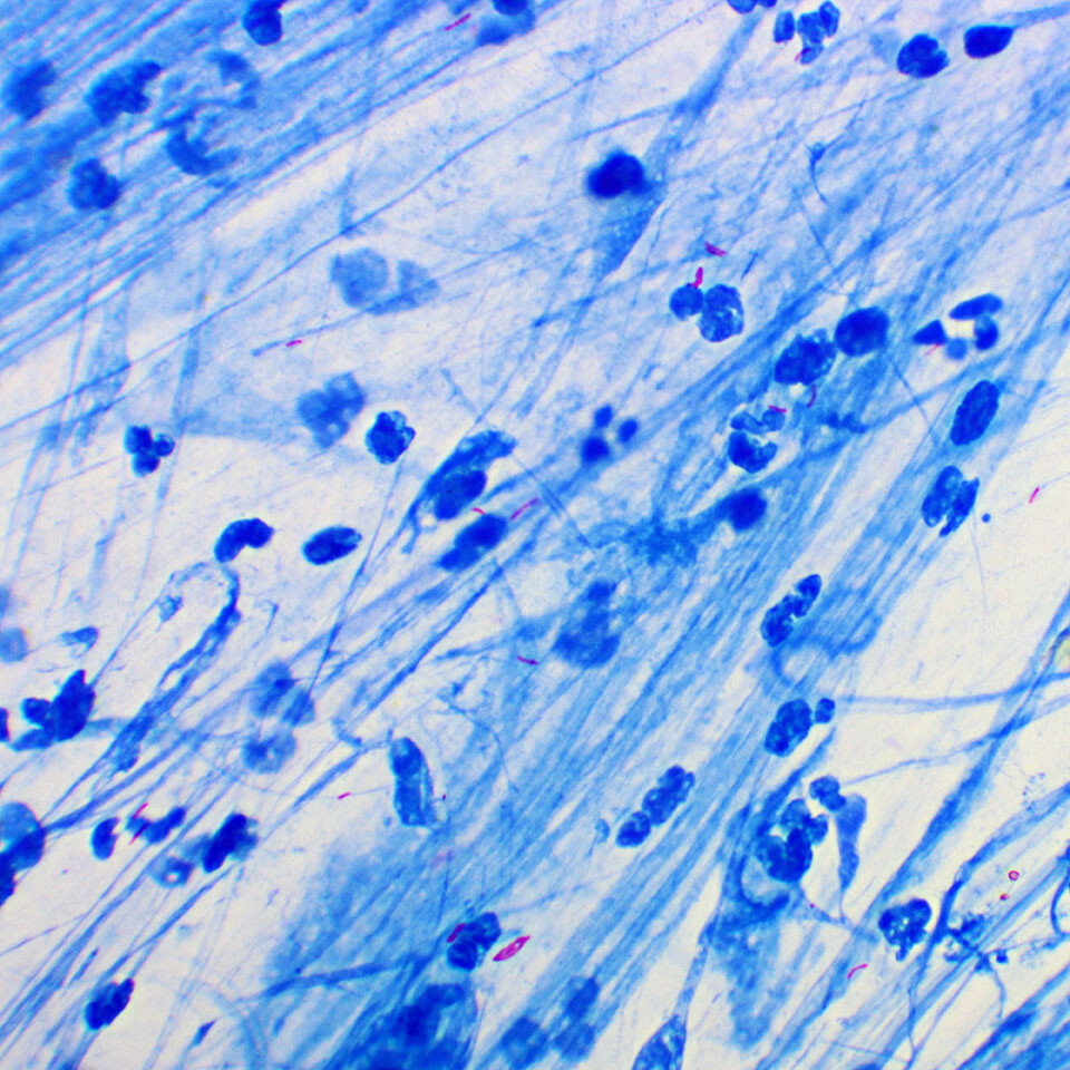 m tuberculosis